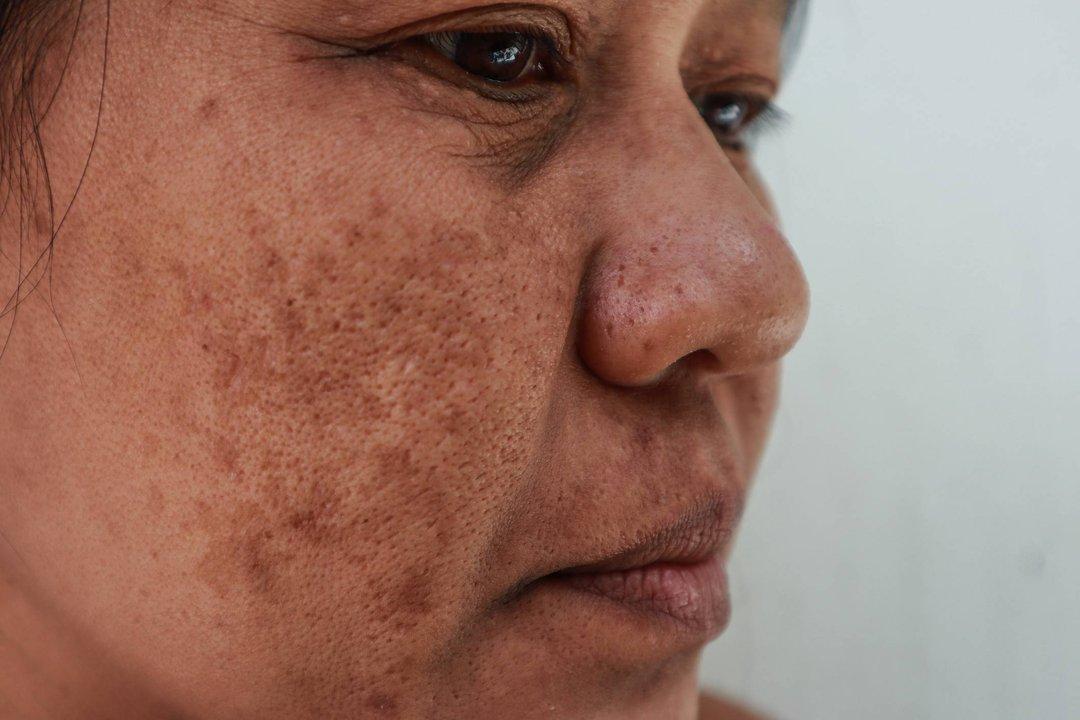 artikel flek noda hitam melasma diricare.com